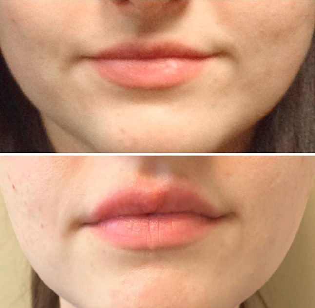 Juvederm Ultra Plus XC  - before and after 