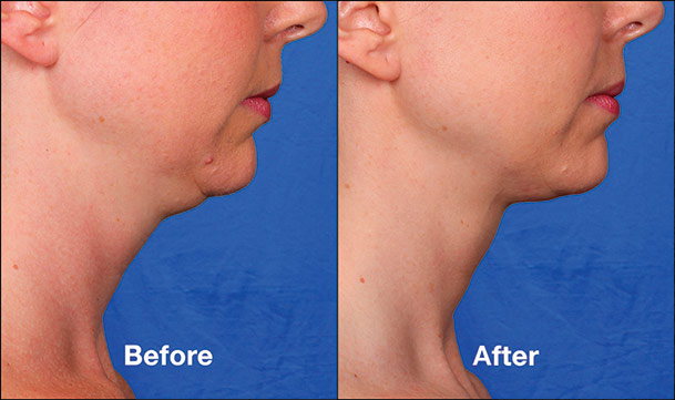 kybella injections for double chin