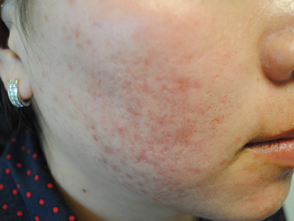 acne treatments after by la nouvelle medical spa oxnard