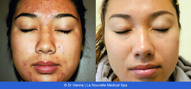 Laser Acne Treatment - acne scars before