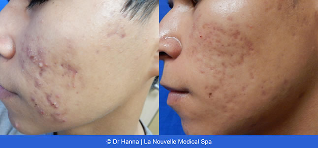 Laser Acne Treatment - acne scars before
