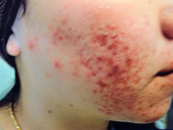 acne treatments before by la nouvelle medical spa oxnard
