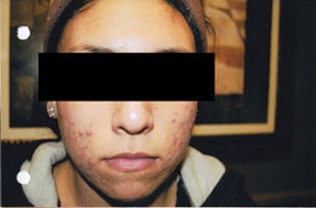acne treatment before and after la nouvelle, oxnard, ventura