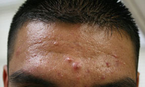 acne treatment before and after dr hanna oxnard, ventura county