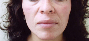 acne treatment before and after la nouvelle, oxnard, ventura