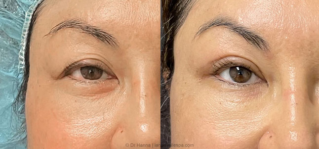 Asian Blepharoplasty upper Eyelid Surgery before after photos Ventura County, Dr. Hanna La Nouvelle Medical Spa, Oxnard