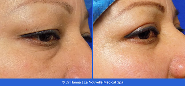 Asian Blepharoplasty Eyelid Surgery before after photos Ventura County, Dr. Hanna La Nouvelle Medical Spa, Oxnard