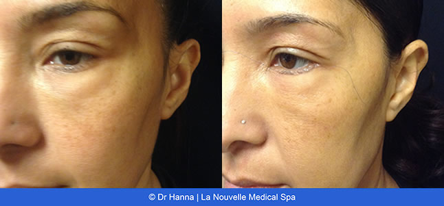 Blepharoplasty Eyelid Surgery before after photos Ventura County, Dr. Hanna La Nouvelle Medical Spa, Oxnard