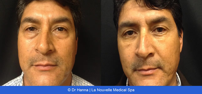 lower Blepharoplasty Eyelid Surgery before after photos Ventura County, Dr. Hanna La Nouvelle Medical Spa, Oxnard