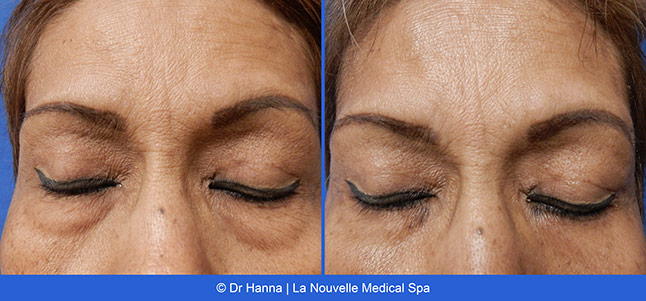 Blepharoplasty lower Eyelid Surgery before after photos Ventura County, Dr. Hanna La Nouvelle Medical Spa, Oxnard