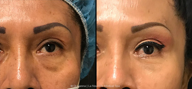 lower Blepharoplasty Eyelid Surgery before after photos front view, Ventura County, Dr. Hanna La Nouvelle Medical Spa, Oxnard