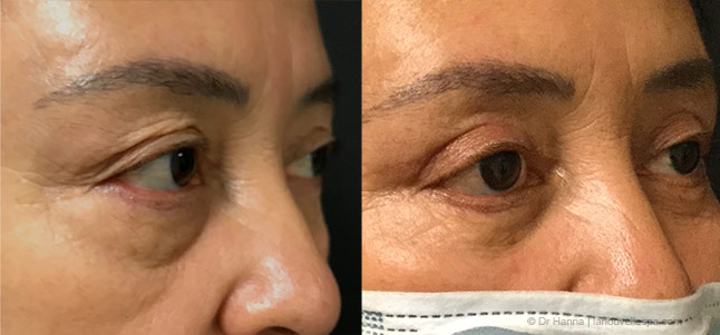 upper and lower Blepharoplasty Eyelid Surgery before after photos Ventura County, Dr. Hanna La Nouvelle Medical Spa, Oxnard