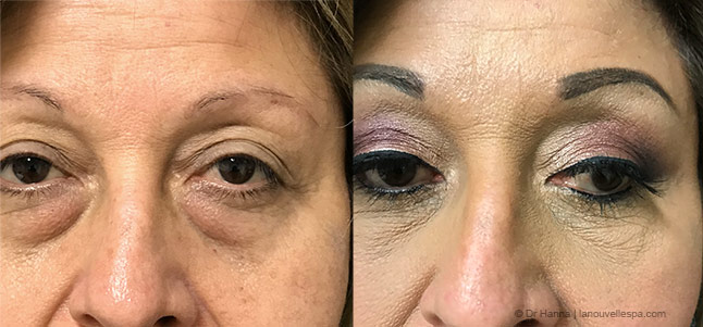 upper and lower Blepharoplasty Eyelid Surgery before after photos Ventura County frontview, Dr. Hanna La Nouvelle Medical Spa, Oxnard