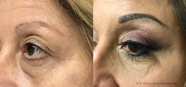 Blepharoplasty Eyelid Surgery before after photos Ventura County left eye, Dr. Hanna La Nouvelle Medical Spa, Oxnard