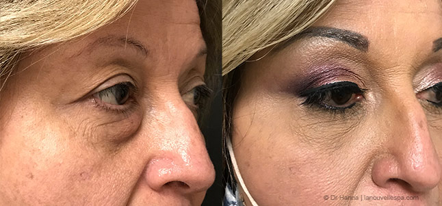 upper and lower Blepharoplasty Eyelid Surgery before after photos Ventura County right eye, Dr. Hanna La Nouvelle Medical Spa, Oxnard