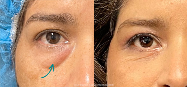 lower Blepharoplasty Eyelid Surgery before after photos Ventura County by dr. Hanna, La Nouvelle Medical Spa, Oxnard