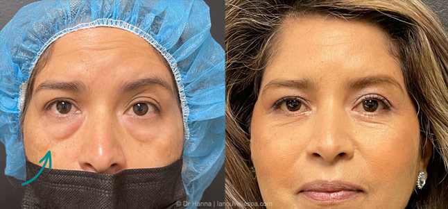 lower blepharoplasty eye bag removal eyelid surgery before and after photos by dr hanna at la nouvelle medical spa oxnard ventura