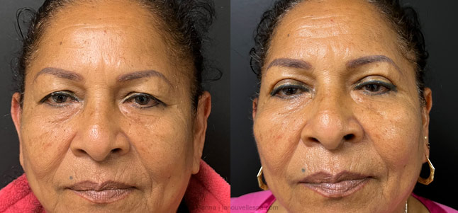 upper Blepharoplasty Eyelid Surgery before after photos Ventura County by dr. Hanna, La Nouvelle Medical Spa, Oxnard