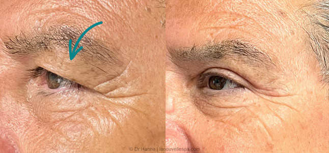 upper Blepharoplasty Eyelid Surgery before after photos Ventura County by dr. Hanna, La Nouvelle Medical Spa, Oxnard