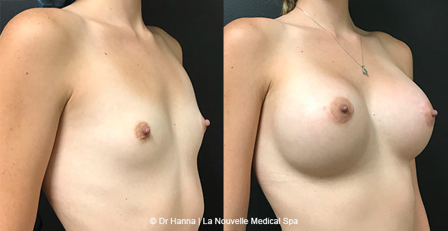 Breast augmentation before and after photos Ventura County, boob job with silicone implants by Dr. Hanna, La Nouvelle Medical Spa