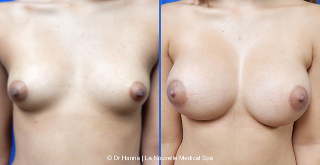 Breast augmentation before and after photos Ventura County, boob job with silicone implants by Dr. Hanna, La Nouvelle Medical Spa, 15