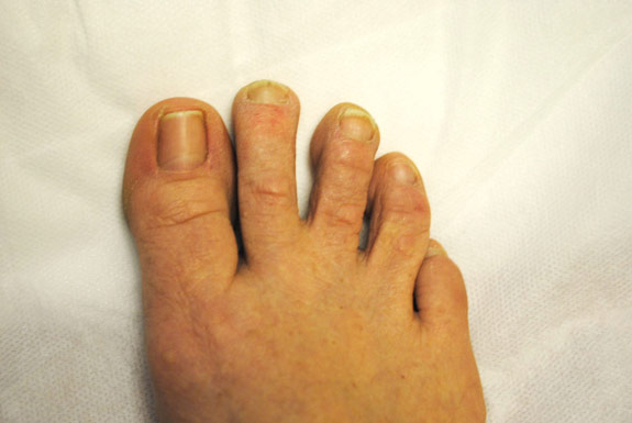 fungus toenail treatments by laser genesis after photo