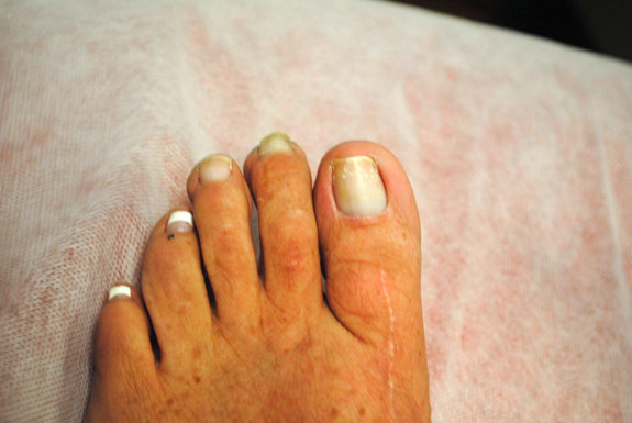 fungus toenail treatments by laser genesis before photo
