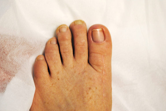 fungus toenail treatments by laser genesis after photo