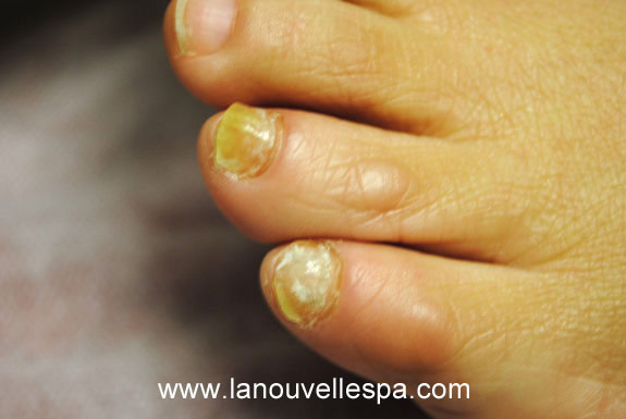 fungus toenail treatments by laser genesis before photo