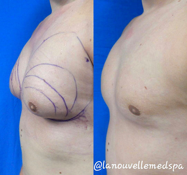 male breast reduction gynecomastia before after la nouvelle medical spa dr hanna ventura county