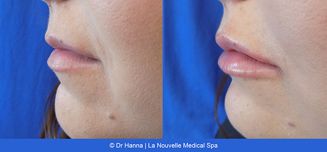 lip enhancement before and after with juvederm and volbella, oxnard
