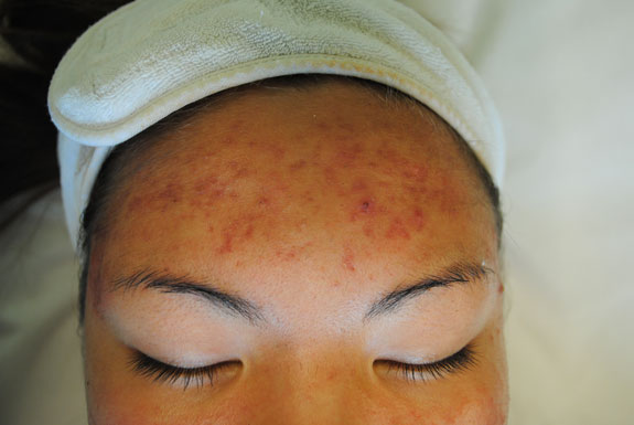 laser genesis and la nouvelle acne line on female forehead by  la nouvelle spa oxnard, before photo