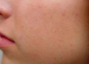 Laser Acne Treatment - acne scarsafter