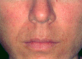 Laser Acne Treatment - after