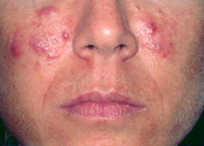 Laser Acne Treatment - before