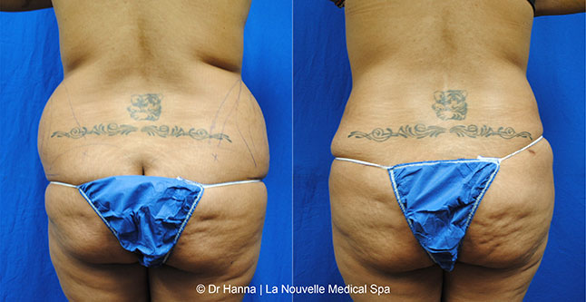 Liposuction, Smartlipo before after photos Ventura County, Dr. Hanna La Nouvelle Medical Spa, Oxnard