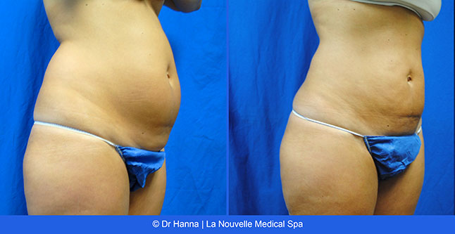 Liposuction, Smartlipo before after photos Ventura County, Dr. Hanna La Nouvelle Medical Spa, Oxnard