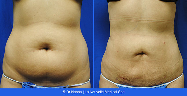 Liposuction, Smartlipo before after photos Ventura County, Dr. Hanna La Nouvelle Medical Spa, Oxnard