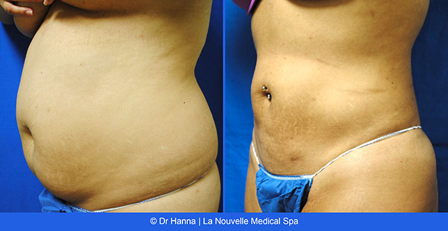 Liposuction, Smartlipo before after photos Ventura County, Dr. Hanna La Nouvelle Medical Spa, Oxnard