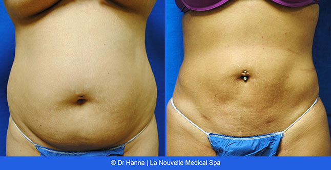 Liposuction, Smartlipo before after photos Ventura County, Dr. Hanna La Nouvelle Medical Spa, Oxnard