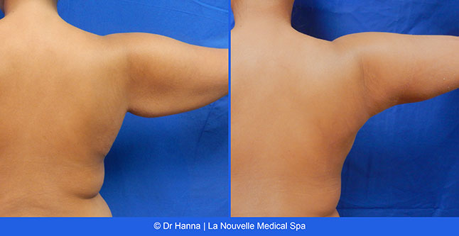 Liposuction, Smartlipo before after photos Ventura County, Dr. Hanna La Nouvelle Medical Spa, Oxnard