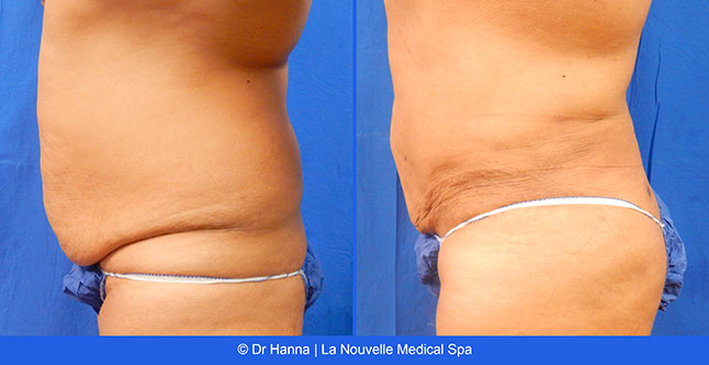 Liposuction, Smartlipo before after photos Ventura County, Dr. Hanna La Nouvelle Medical Spa, Oxnard