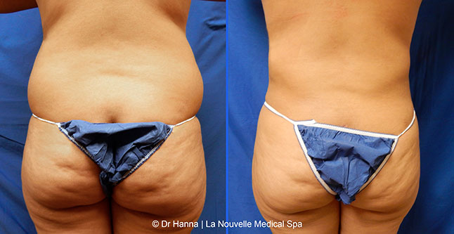 Liposuction, Smartlipo before after photos Ventura County, Dr. Hanna La Nouvelle Medical Spa, Oxnard