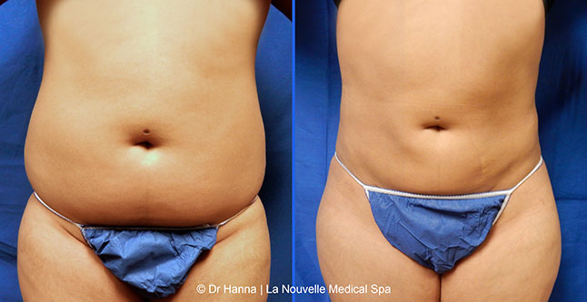 Liposuction, Smartlipo before after photos Ventura County, Dr. Hanna La Nouvelle Medical Spa, Oxnard