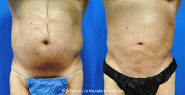 Liposuction, Smartlipo before after photos Ventura County, Dr. Hanna La Nouvelle Medical Spa, Oxnard