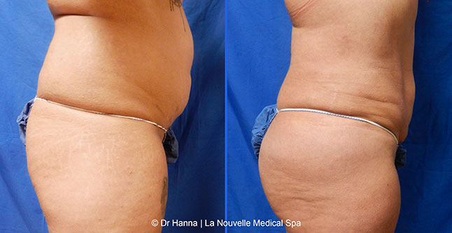 Liposuction, Smartlipo before after photos Ventura County, Dr. Hanna La Nouvelle Medical Spa, Oxnard