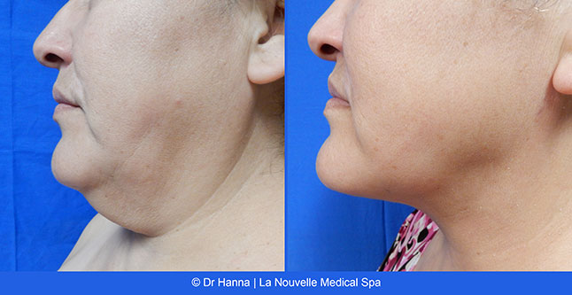 Liposuction, Smartlipo before after photos Ventura County, Dr. Hanna La Nouvelle Medical Spa, Oxnard