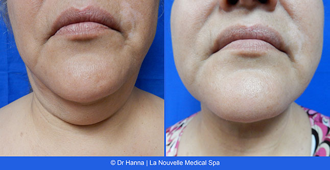 Liposuction, Smartlipo before after photos Ventura County, Dr. Hanna La Nouvelle Medical Spa, Oxnard