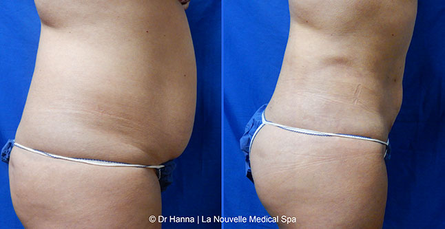 Liposuction, Smartlipo before after photos Ventura County, Dr. Hanna La Nouvelle Medical Spa, Oxnard