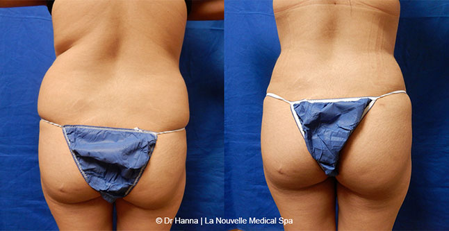Liposuction, Smartlipo before after photos Ventura County, Dr. Hanna La Nouvelle Medical Spa, Oxnard